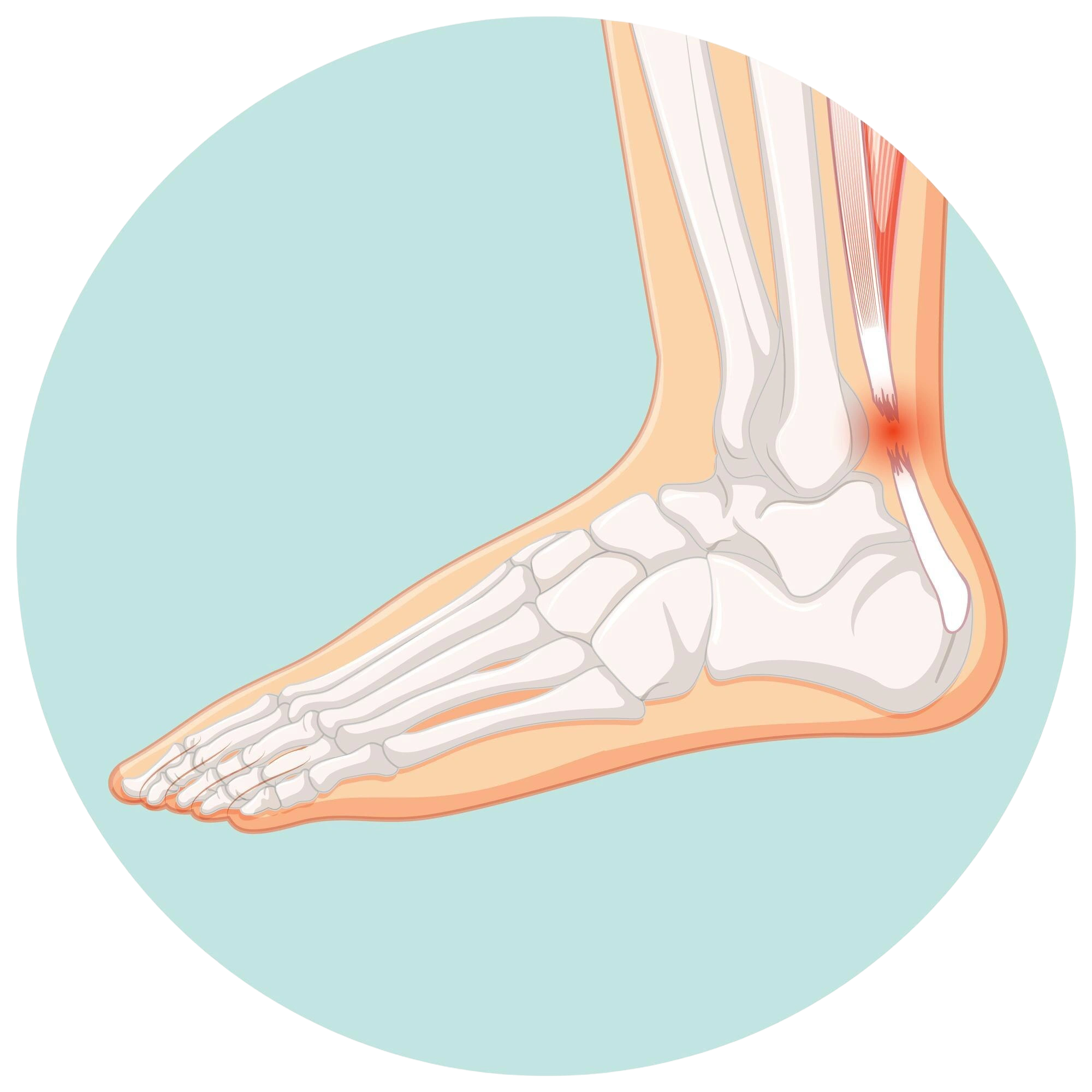 Clubfoot Clubfoot