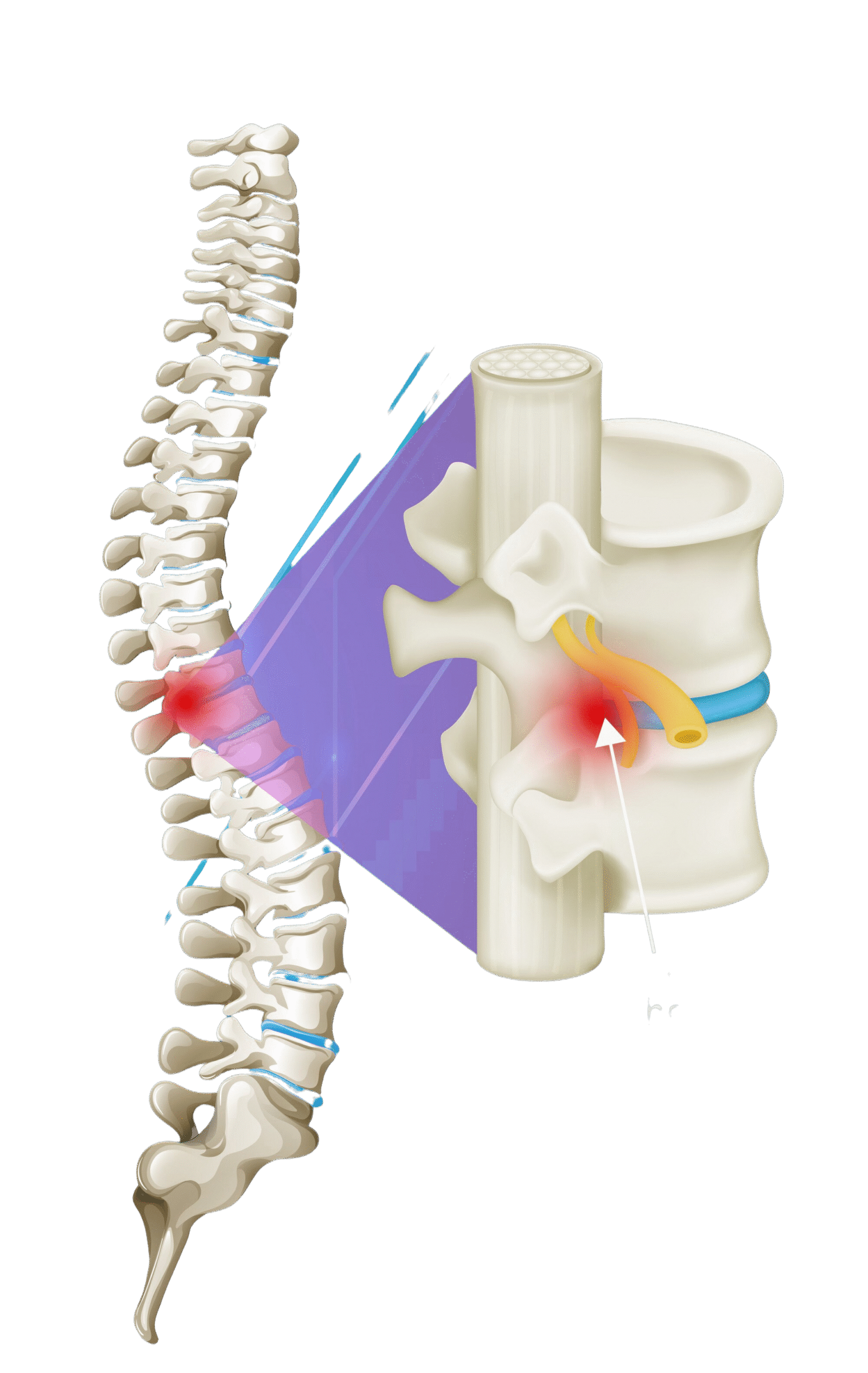 diagram-pinched-nerve-spinal-cord